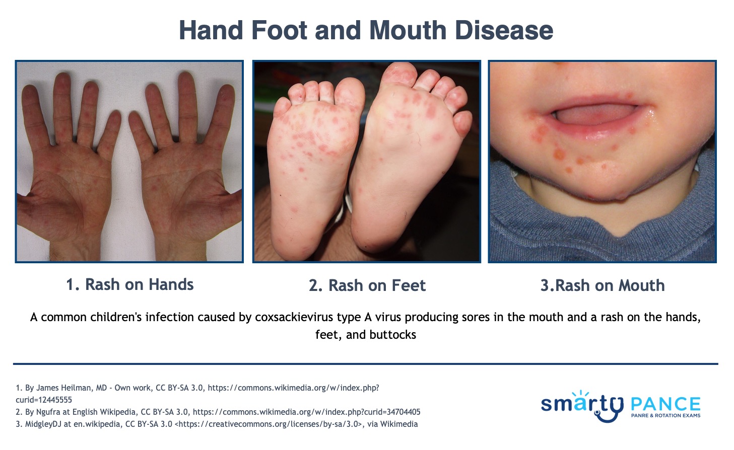 What Does Hand Foot Mouth Disease Look Like In Esperanza Rising 