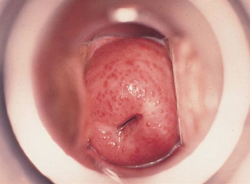 Strawberry cervix.