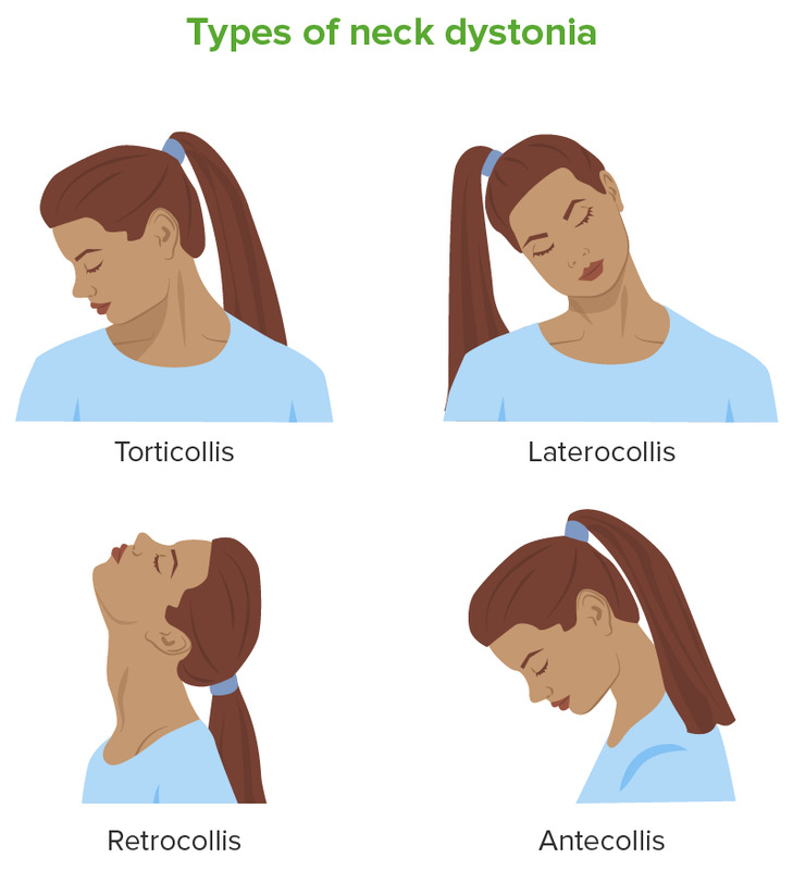 Torticollis Musculoskeletal System Blueprint Smarty PANCE