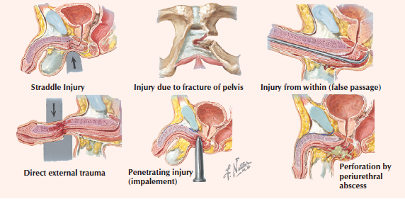 Genitourinary trauma | SMARTY PANCE male reroductive system diagram 