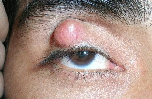 A chalazion is a painless granuloma of the internal meibomian sebaceous gland (PAINLESS LID NODULE)