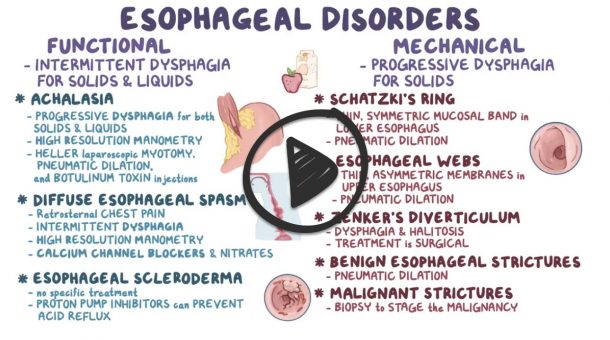 Esophageal strictures - Smarty PANCE