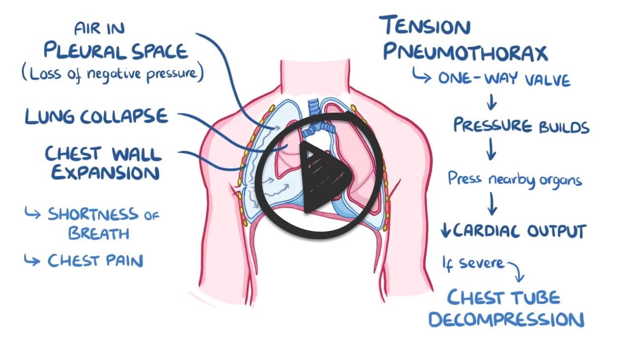 Pneumothorax (ReelDx) - Smarty PANCE
