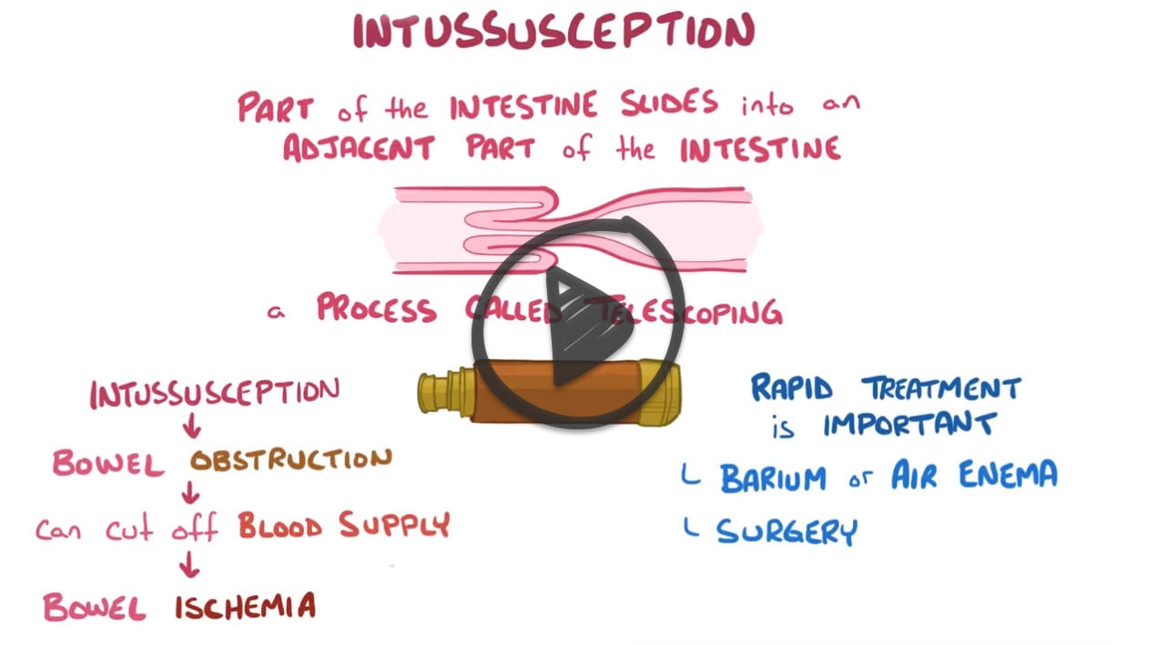 Intussusception Reeldx Smarty Pance