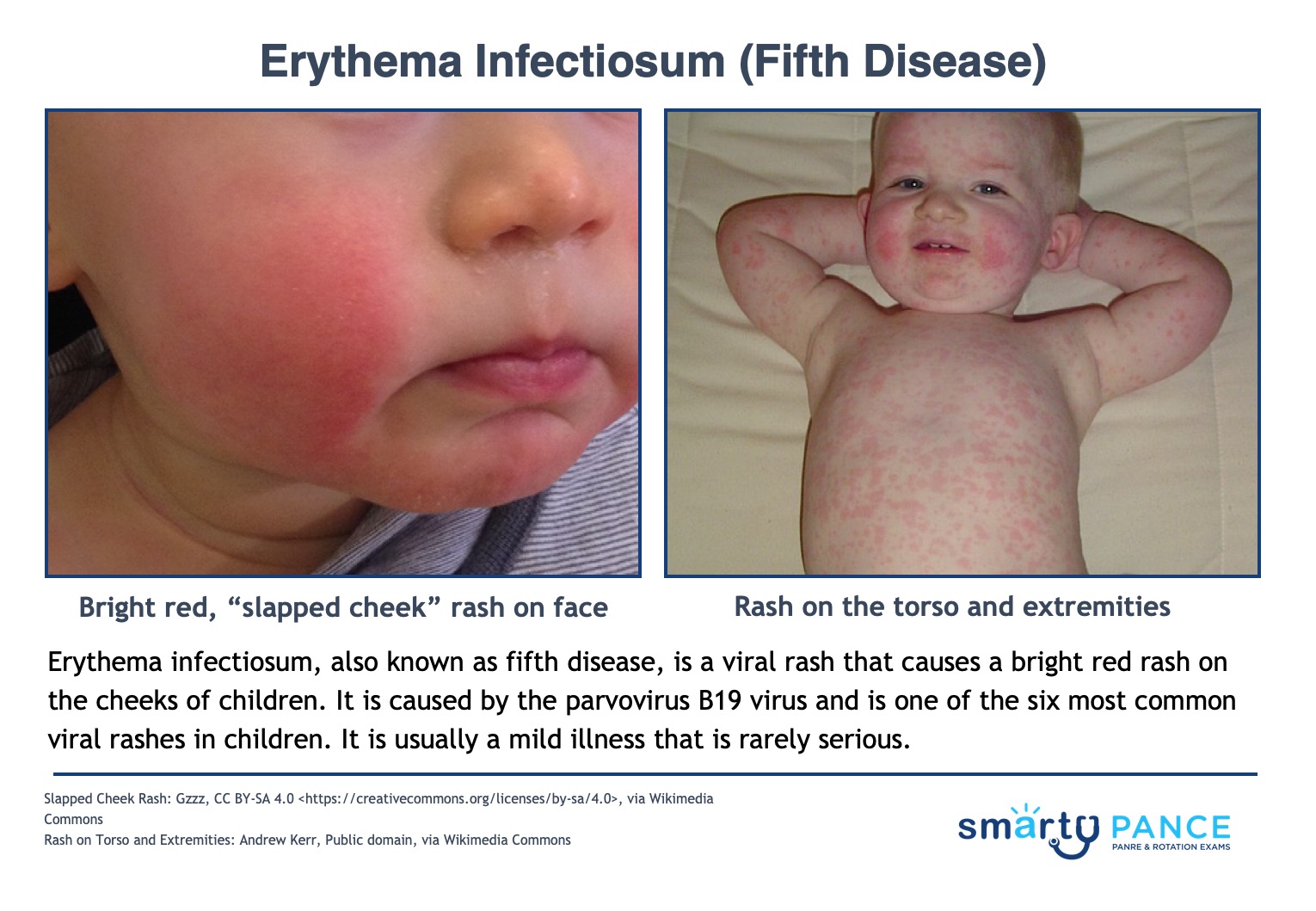 Erythema infectiosum (Lecture + ReelDx) - Smarty PANCE