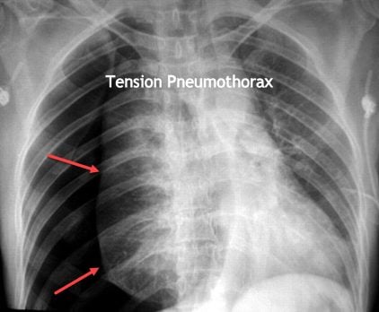 Tension Pneumothorax