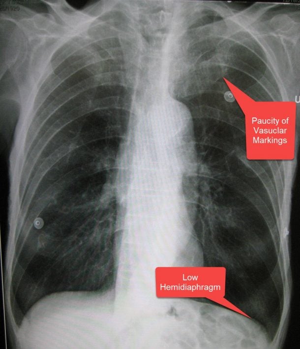Emphysema Smarty PANCE