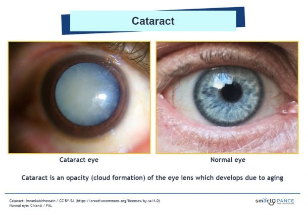 Cataracts | EENT Content Blueprint - Smarty PANCE | PANRE