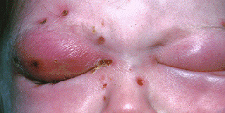 Jonathan Trobe, MD - University of Michigan Kellogg Eye Center (https://commons.wikimedia.org/wiki/File:Orbital_cellulitis.jpg), "Orbital cellulitis", crop by Stephen Pasquini PA-C, https: // creativecommons. org / licenses / by / 3.0 / legalcode