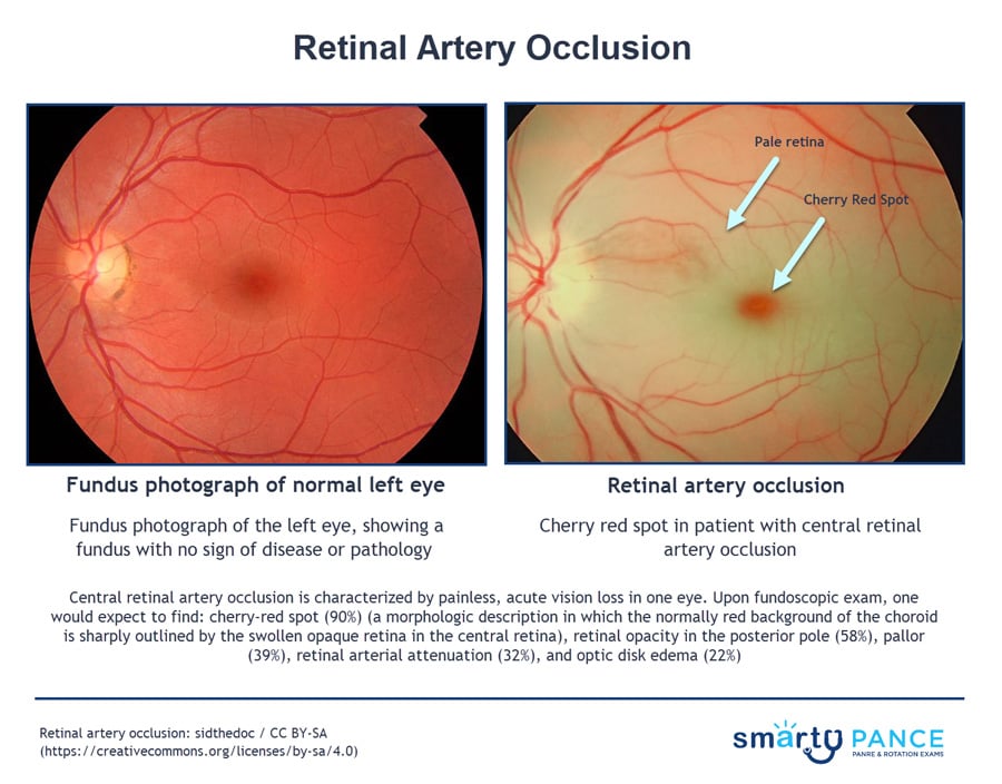 central retinal artery anatomy