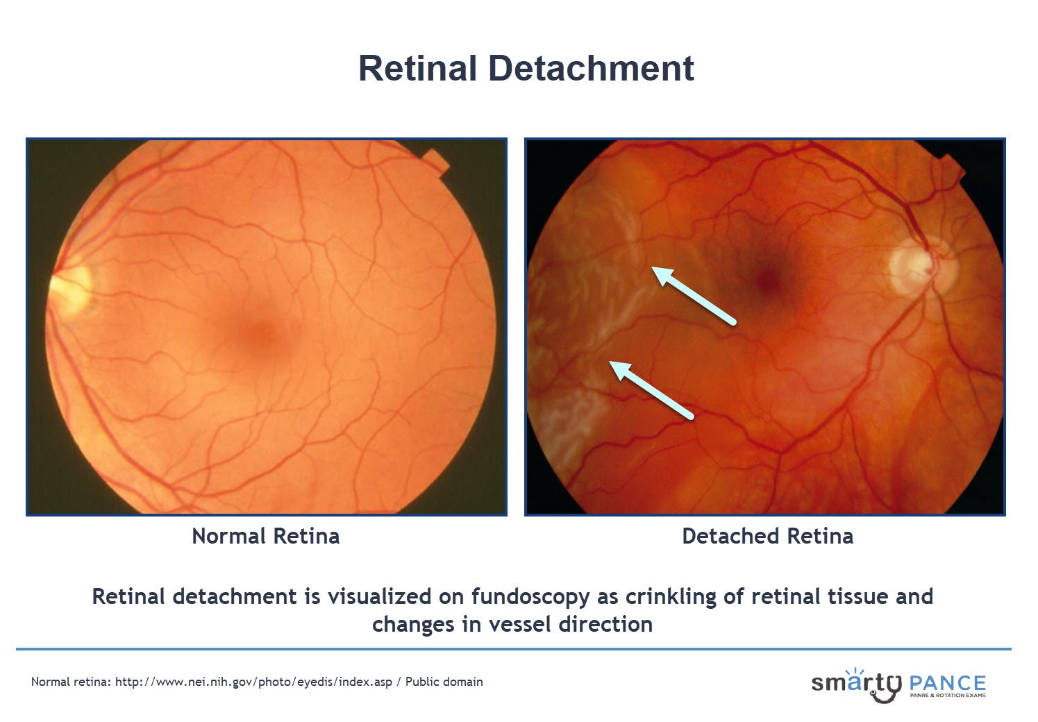 Cataract surgery after retinal detachment
