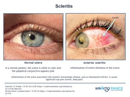 Scleritis | EENT PANCE Content Blueprint - Smarty PANCE