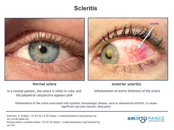 scleritis-eent-pance-content-blueprint-smarty-pance