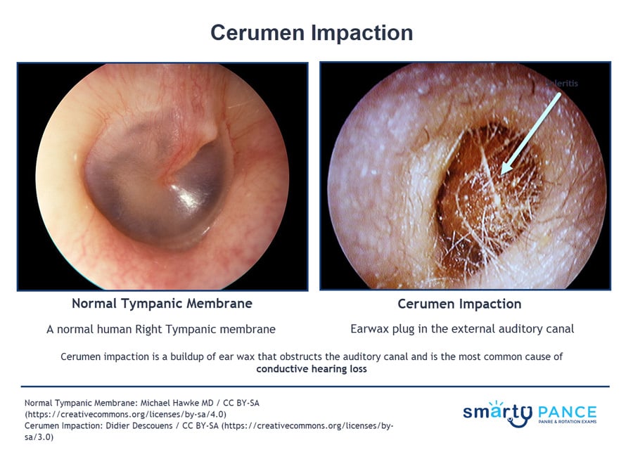 normal tympanic membrane