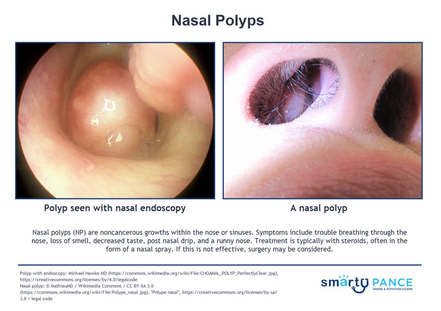 large nasal polyps