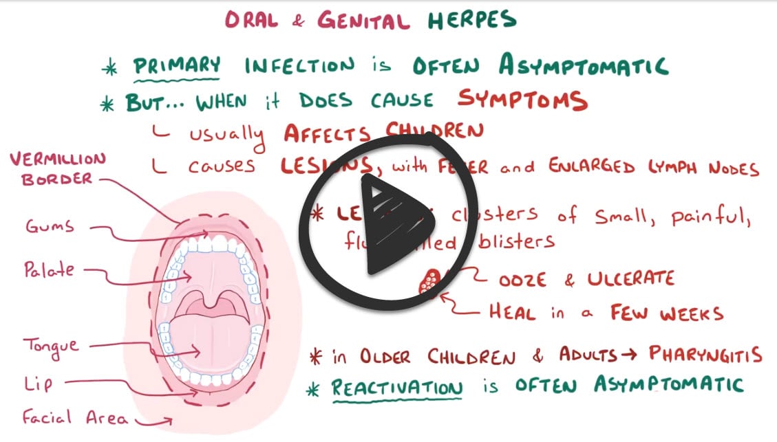 Oral herpes simplex (ReelDx) - Smarty PANCE