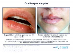 Oral herpes simplex (ReelDx) - Smarty PANCE