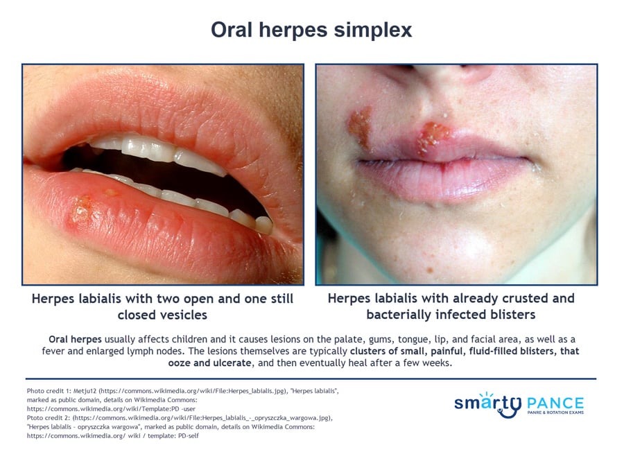 ReelDx Virtual Rounds (Oral herpes simplex) .
