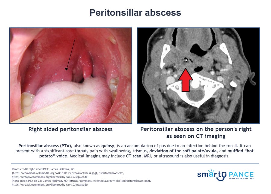 Peritonsillar Abscess Pance Eent Content Blueprint Smarty Pance