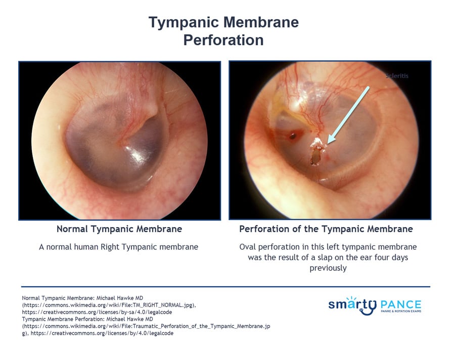 tympanic membrane abnormal
