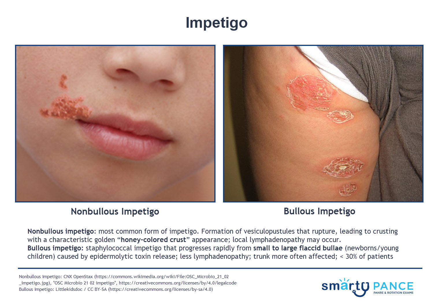 Impetigo Bulosa Nikolsky