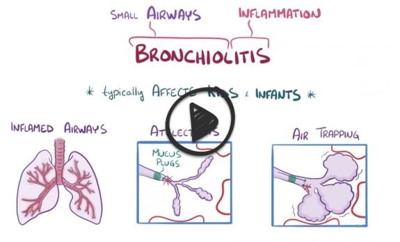 Acute bronchiolitis (ReelDx) | Pulmonary Blueprint - Smarty PANCE