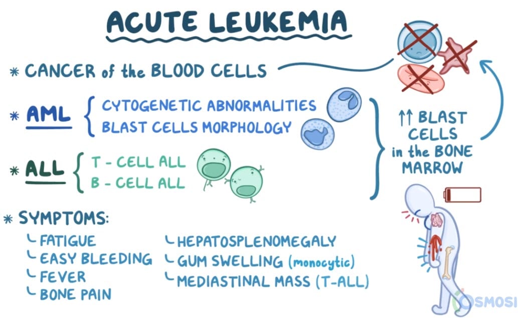Acute And Chronic Lymphocytic Leukemia Hematology Blueprint Smarty