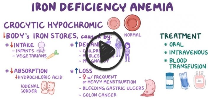 Iron Deficiency Anemia Hematology Content Blueprint Smarty Pance 8764