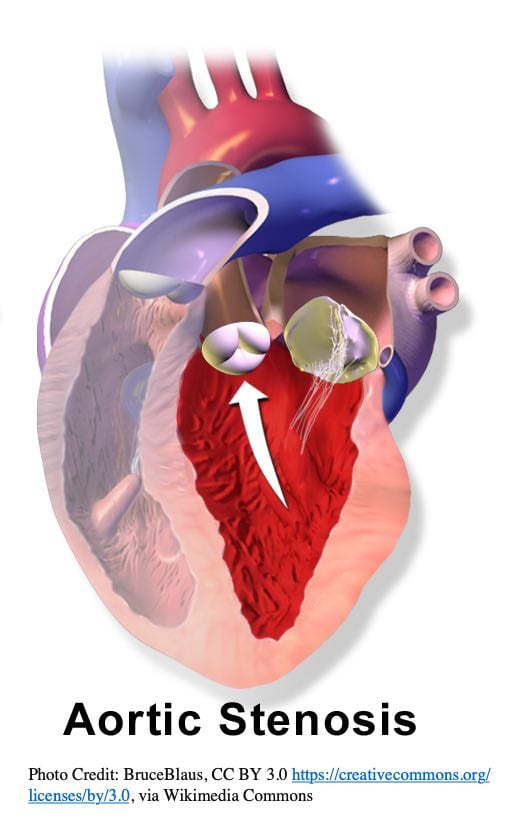 Podcast Episode 91: Cardiac Murmurs Made Incredibly Easy (Part 1 of 5 ...