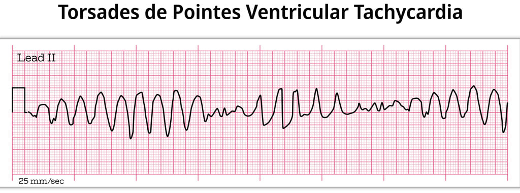 Torsades de pointes