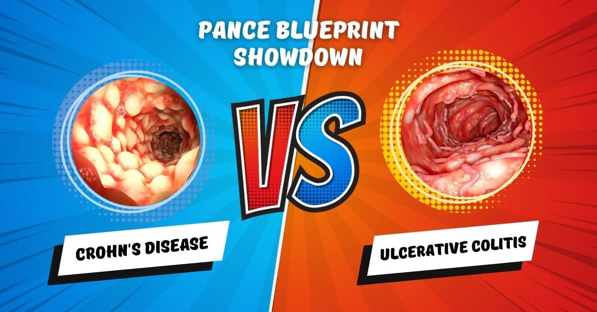 PANCE Blueprint Showdown: Crohn's Disease vs. Ulcerative Colitis