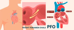 A patent foramen ovale (PFO)
