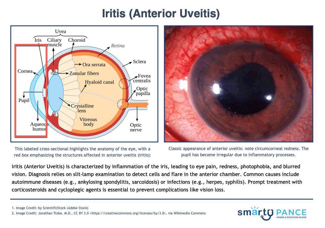 Posterior Synechiae In Anterior Uveitis Posterior Synechiae In Anterior Uveitis
