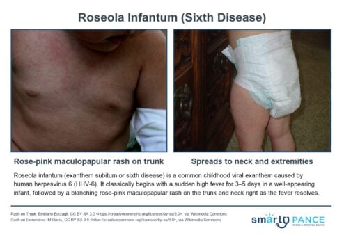 Roseola Infantum (Sixth Disease)