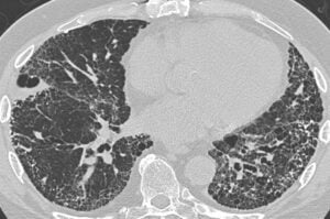 CT showing usual interstitial pneumonia with basal subpleural honeycombing